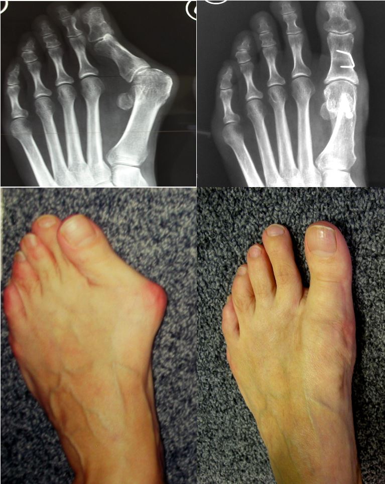 Вальгусная деформация первого пальца стопы (Hallux Valgus) - ортопедическая...